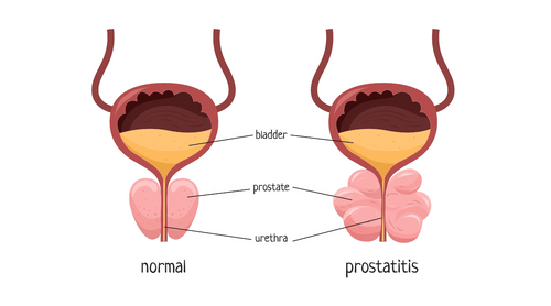 Is Chronic Pain a Sign of Prostatitis? Discover the Symptoms You Shoul